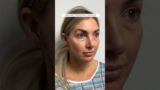 Trifecta Lift amp Duplex Combination Treatment with Dr Kami Parsa [upl. by Wolfgang]