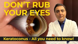 All you need to know about Keratoconus [upl. by Alain]