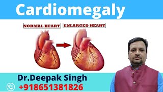 Cardiomegaly  Increase size of heart  Deepak PD Singh [upl. by Rheba]