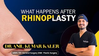 What Happen After Rhinoplasty  bodygoals rhinoplastyexpert skincare nosejob nose face [upl. by Mailliw]