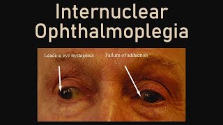 Internuclear Ophthalmoplegia [upl. by Nine]