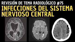 Revisión de Tema 75 Infecciones del sistema nervioso central SNC [upl. by Kiran]