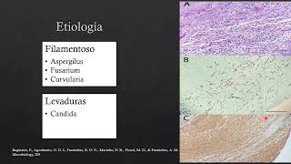 Queratitis Micótica 10224 [upl. by Laeynad749]