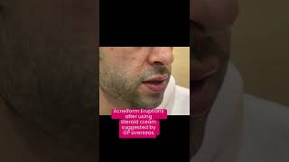 Acneiform Eruptions  Say no to steroid creams Dr Ashima Goel MD dermatologist [upl. by Eindys240]