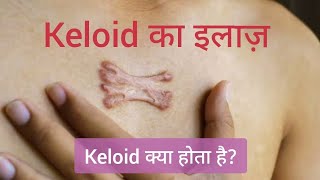 Keloid का इलाज  Hypertrophic Scar  Keloid treatment  keloid injection treatment  keloid scar [upl. by Ueihttam]