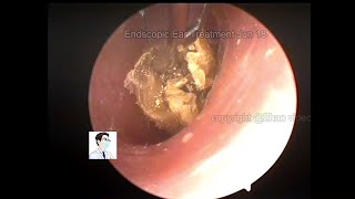 Ear Wax Removal Cerumen Cleaning Collection20220618 [upl. by O'Kelly385]