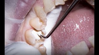 Treating secondary caries with Biodentine by Dr Nicola Bone [upl. by Burnett862]