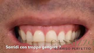 Come curare il SORRISO GENGIVALE [upl. by Alidis]