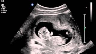 Jumping womb dancer baby ultrasound scan [upl. by Adnoryt]