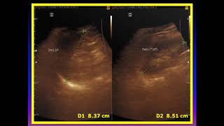 Ultrasound cases 453 of 2000  Complex right ovarian mass [upl. by Halak]