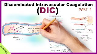 DIC Disseminated Intravascular Coagulation  Part 1 [upl. by Atina]