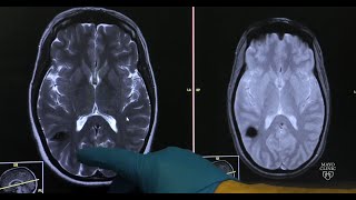 Cavernous malformations — Neurovascular disease explained [upl. by Hardigg]