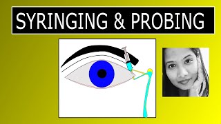 Lacrimal Syringing amp Probing  Procedure amp Interpretation of Results [upl. by Nilson257]