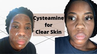 Cysteamine Cream for Clear Skin  Dark Skin [upl. by Aryajay]