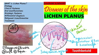 Oral Lichen planus Part 1 Causes Pathogenesis Clinical features Skin lesions [upl. by Sucam]