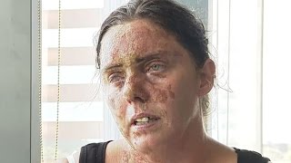 Acid attack victim describes ordeal [upl. by Nylyahs141]