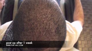 FUE Hair Transplant Hair Transplant Repair Hairline Clinic [upl. by Ahseym]