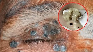 Blackhead Removal on his nose  Acne Treatment  Remove Blackhead removeblackhead [upl. by Etteuqaj]