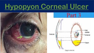 Hypopyon Corneal Ulcer keratitis part 3 [upl. by Drusi]