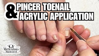 Fix for Yellow Toenails at Home nails satisfying [upl. by Aynotan]