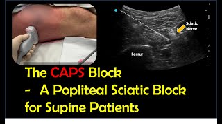 Lateral Popliteal Sciatic Block for Supine Patients CAPS block [upl. by Bum]