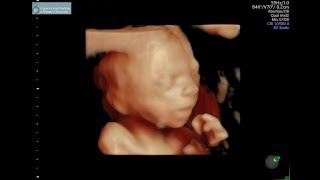 20 week ultrasound [upl. by Yona]