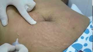 Carboxiterapia nas Estrias em Abdome [upl. by Evie]