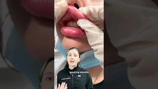 What are the risk of overfilled lip filler Dr Medispa [upl. by Hamas]