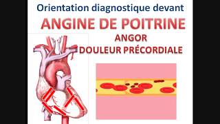 Syndrome coronarien aigu ANGINE DE POITRINE angor stable instable cours cardiologie conduite à tenir [upl. by Roobbie]