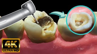 Endodoncia en muela con caries profunda  Tratamiento de conducto [upl. by Nedap638]