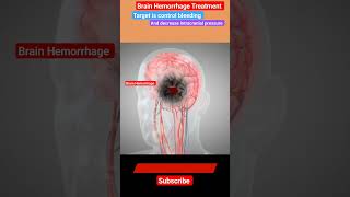 Brain Hemorrhage Treatment l Mannitol l Craniotomy stroke shorts [upl. by Meekyh]