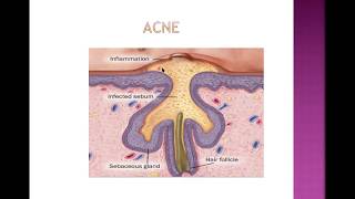 Acne vulgaris [upl. by Donni]