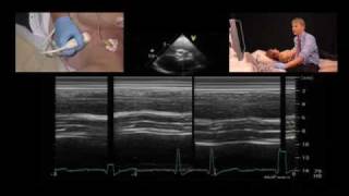 Aortic Valve Bioprosthesis [upl. by Riatsala]