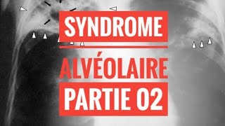 Syndrome Alvéolaire  partie 02 [upl. by Nicole]