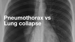 PNEUMOTHORAX Types Causes Diagnosis amp Treatment  Detailed video [upl. by Taite]