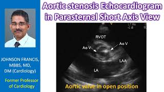 Aortic stenosis Echocardiogram in parasternal short axis view [upl. by Eendyc993]