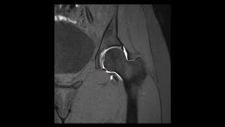 Hip MRI Arthrogram Contrast in Joint Normal No Pathology [upl. by Iruam]