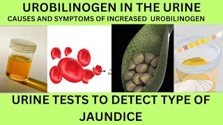 UROBILINOGEN IN THE URINE INCREASEDCAUSES SYMPTOMS OF HIGH UROBILINOGENURINE TEST FOR JAUNDICE [upl. by Annirtak]