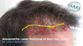 Alexandrite Laser Removal of Bad Hair Grafts [upl. by Eelyam]