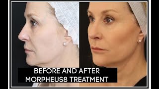 BEFORE AND AFTER MY MORPHEUS 8 TREATMENT [upl. by Orabla]