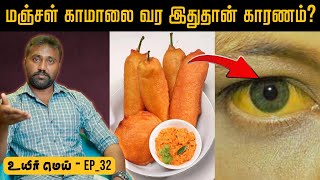 Causes of Gall bladder stone  பித்தப்பை பிரச்சனைய அலட்சியப்படுத்தாதீங்க  Uyirmei Ep32 [upl. by Retsehc]