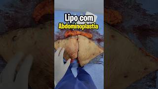 TIROU 😱 18KG PELE NA ABDOMINOPLASTIA cirurgiaplastica abdominoplastia lipohd drvalterhugo [upl. by Etnahs]