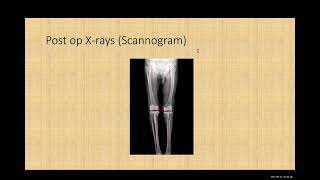 461 06 An interesting windswept deformity of the knees by Dr Arun Kannan [upl. by Killy]