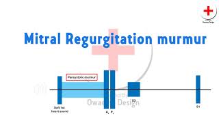 Mitral regurgitation murmur [upl. by Htezzil]