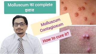 Molluscum Contagiosum Treatment  molluscum contagiosum removal  molluscum contagiosum in Hindi [upl. by Iain516]