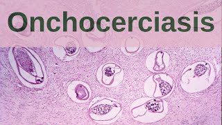 What is Onchocerciasis  Pathology mini tutorial [upl. by Sneed]