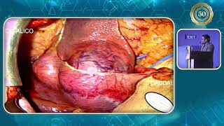 Utilización del Verde Indocianina en el Manejo Quirúrgico de Carcinoma Hepatocelular Reporte De C [upl. by Lekkim]