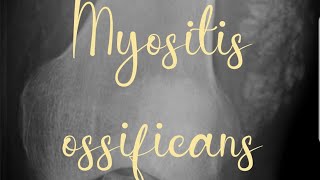 Myositis Ossificans  ORTHOPEDICS LECTURES [upl. by Moule]