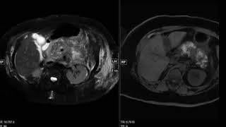 Abdominal Case Conference  772020 [upl. by Elke]