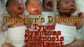 Gaucher Disease  Types symptoms diagnosis treatment  MisMedicine [upl. by Garrick]